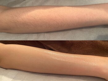 ディオーネ 西船橋駅前店(Dione)/ひじ下脱毛◇Before After