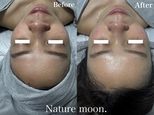 ナチュールムーン(Nature moon.)/ハーブピーリング