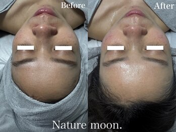 ナチュールムーン(Nature moon.)/ハーブピーリング
