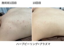 ウェルビー(Well-Be)/ハーブピーリング＋プラズマ