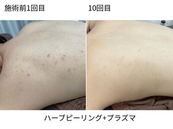 ウェルビー(Well-Be)/ハーブピーリング＋プラズマ