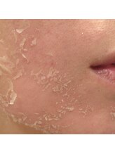 デール(R:DeeL)/お肌の脱皮しませんか？