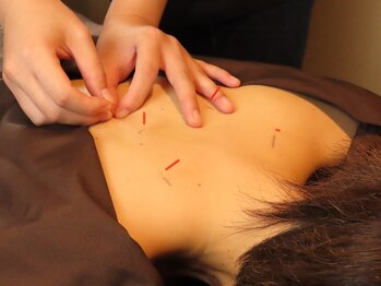 リ フリー 宮の森店(Re'free)/頑固な肩こりには鍼灸がオススメ