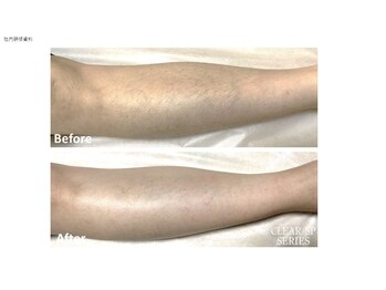 ヴィヴァーチェ(Vivace)/脚脱毛　Before→after