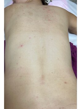 スキンケアスタジオ アコ 新宿店(Aco)/グリーンピールボディ１D前