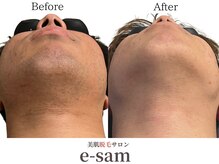 イーサム 高槻摂津富田店(e-sam)/髭脱毛