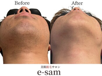イーサム 高槻摂津富田店(e-sam)/髭脱毛