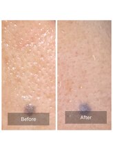 グリーンノート(GREEN NOTE)/ハ－ブピ－リング