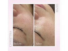 シャルムパリス(charme paris)/ラメ感艶肌に◎１回の施術変化