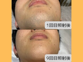 マナ バイ オハナ 横浜関内(mana by ohana)/ヒゲ脱毛／ビフォーアフター