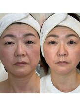 エヴェリーナ(Eveliiina)/ホワイトスノーピール