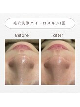 ノドカ 熊本駅前店(NODOKA)/毛穴洗浄でざらつき・くすみケア