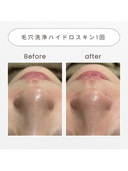 ノドカ 熊本駅前店(NODOKA)/毛穴洗浄でざらつき・くすみケア