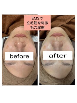 シロ(SHIRO)/EMSで毛穴引き締め♪