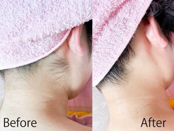 ライトウェーブ 松本村井本店/えり足脱毛 ビフォーアフター