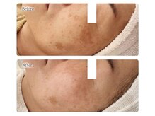 オービーエム 博多阪急店(O.B.M)/【40代シミケア症例】