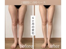 アルムビューティールーム(aLeum Beauty Room)の雰囲気(下半身集中ケア◇インディバ120分/2週間に1回ペース)