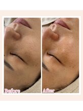 ミラビューティー(Mira Beauty)/40代女性症例