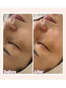 ミラビューティー(Mira Beauty)/40代女性症例