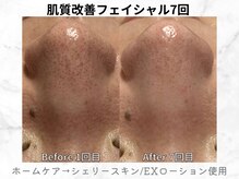 リライン(ReLine)/【リアボーテフェイシャル7回】