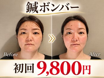 ラ コンシェル たまプラーザ店の写真/【大人の本気エイジングケア】たるみ・ほうれい線・フェイスラインのもたつきに、本格美容鍼★