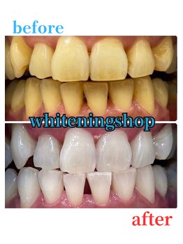ホワイトニングショップ 豊田店(WHITENING SHOP)/ホワイトニングの効果