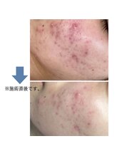 レベンディス(LEVENDIS)/ニキビケア★ハーブピーリング