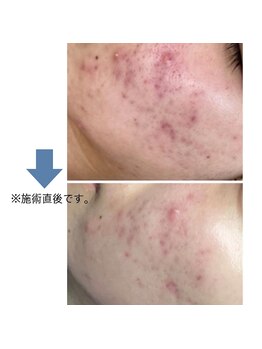 レベンディス(LEVENDIS)/ニキビケア★ハーブピーリング