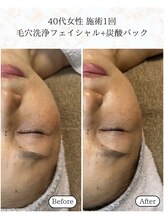 シーフェイス 横浜店(SEE FACE)/毛穴洗浄フェイシャル炭酸パック