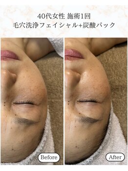 シーフェイス 横浜店(SEE FACE)/毛穴洗浄フェイシャル炭酸パック