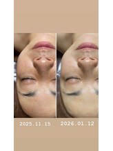 コルッソ(CoLusson.)/速攻美白ホワイトスノーピール