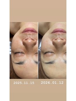 コルッソ(CoLusson.)/速攻美白ホワイトスノーピール