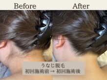 インベスト(INVEST)/うなじ脱毛