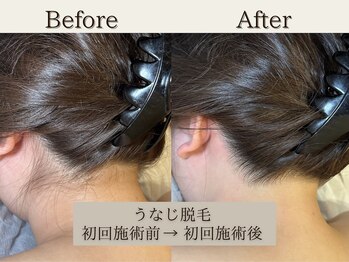 インベスト(INVEST)/うなじ脱毛