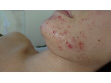 サロンエム(Salon m)/本格ニキビケア