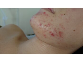 サロンエム(Salon m)/本格ニキビケア