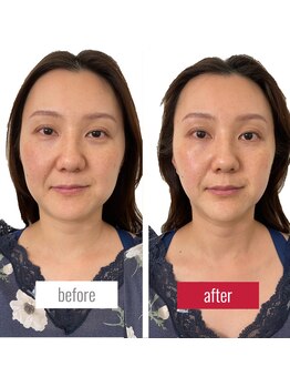 サロンチオリ 烏丸(Salon Chiori)/《50代》顔幅締まる小顔矯正