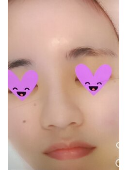 サナティオ(SANATIO)/ニキビケア陶器肌！ハイドラ