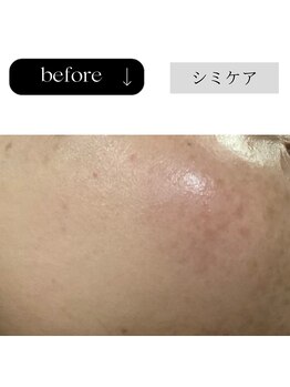 アイチューズ(ICHOOSE)/ホワイトニングピールの結果