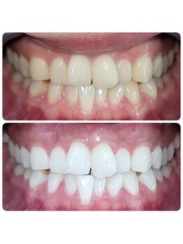 ホワイトニングセンター 広島福山駅前店/福山市・尾道市ホワイトニング