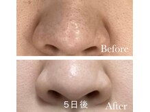 MMK/毛穴つるん☆ピカーン☆