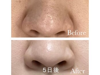 MMK/毛穴つるん☆ピカーン☆