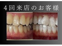 エランホワイトニング 一社店/症例写真