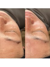 トイロ(toiro)/フェイシャルWax脱毛