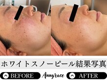 アングレイス(Anngrace)/【本気の肌質改善！】圧倒的効果