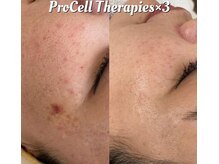 ルイース(LOUISE.)/プロセルセラピーズ肌質改善