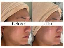 ハリスキンラボ(Hari.Skin.Lab)/30代のお客様/1回の施術効果