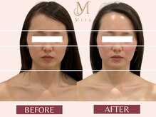 ミラ 札幌店(Mira)/【小顔フルコース】