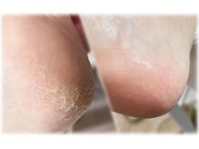アイリス(iris)の雰囲気（【自信あり】ガサつき踵も、一回でフワフワに◎巻き爪矯正も可能）