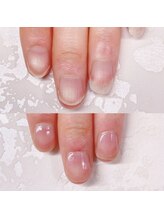 メイル(MEILU)/コンプレックス爪/悩み爪